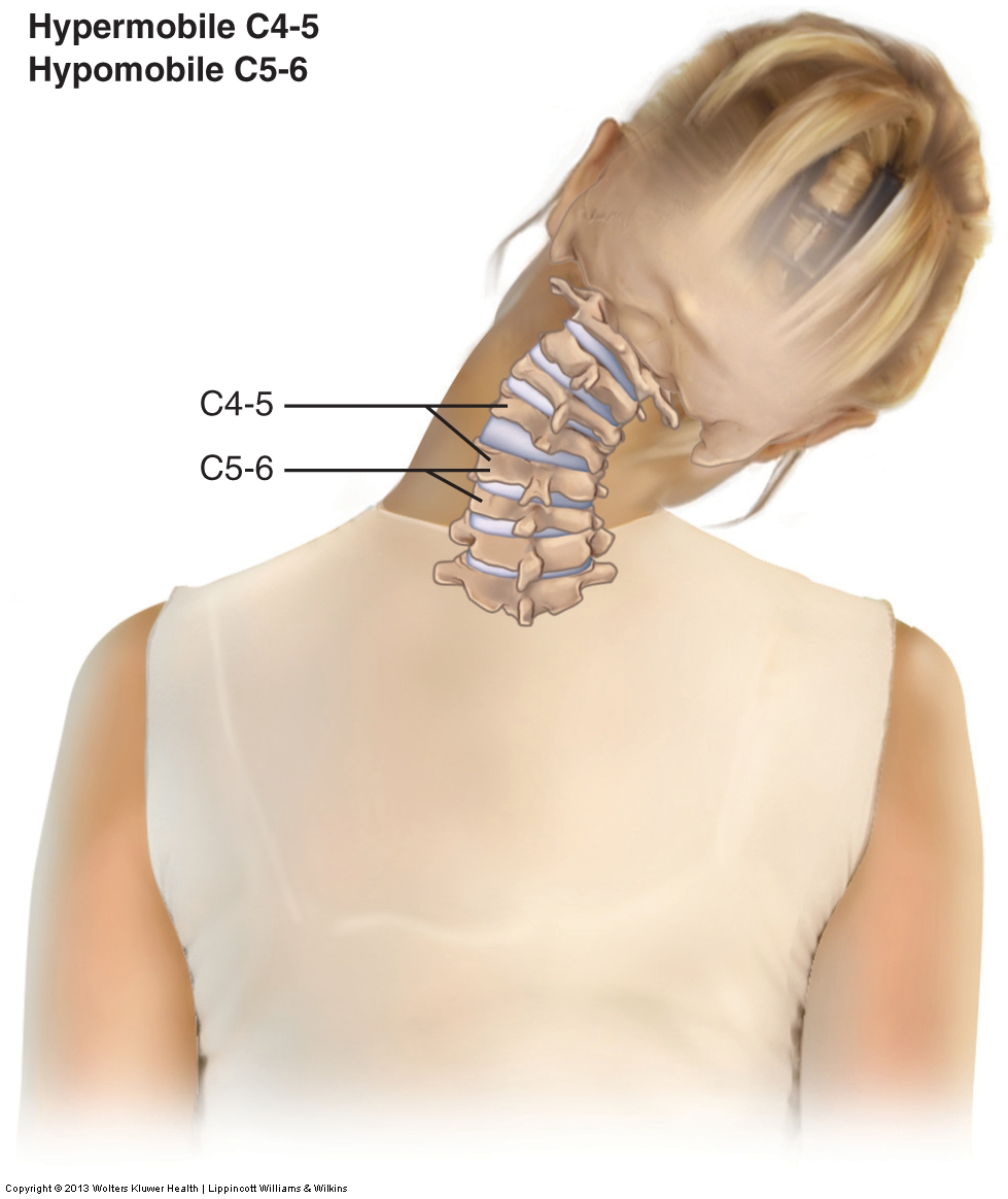 Joint (subluxation, misalignment) of the Spine