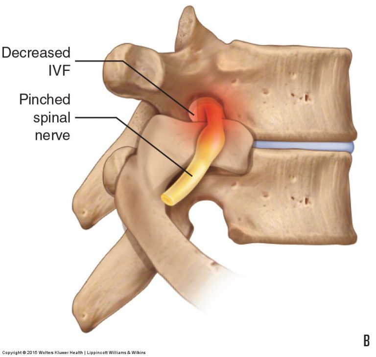 Pathologic Disc Conditions Of The Lumbar Spine And Sciatica