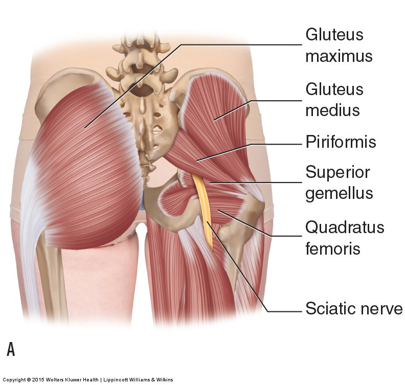 Piriformis Syndrome (entrapment of the sciatic nerve causing sciatica)
