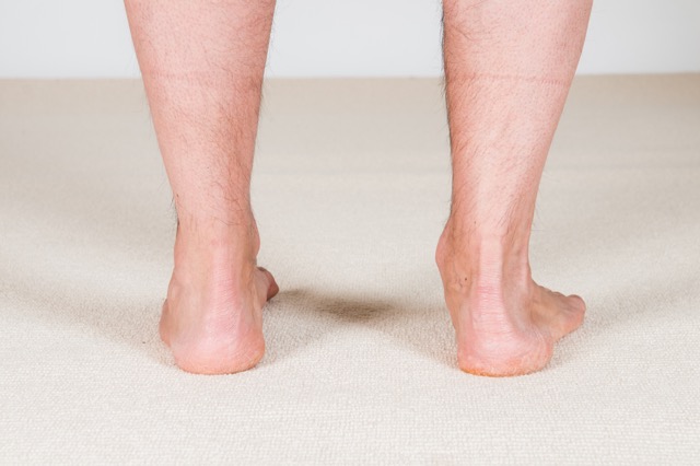 overpronation involves excessive eversion of the foot, in other words a dropped arch