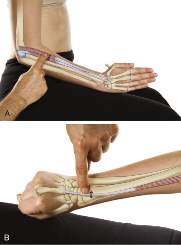 tennis elbow involves pain in the common extensor belly/tendon at the lateral epicondyle of the humerus