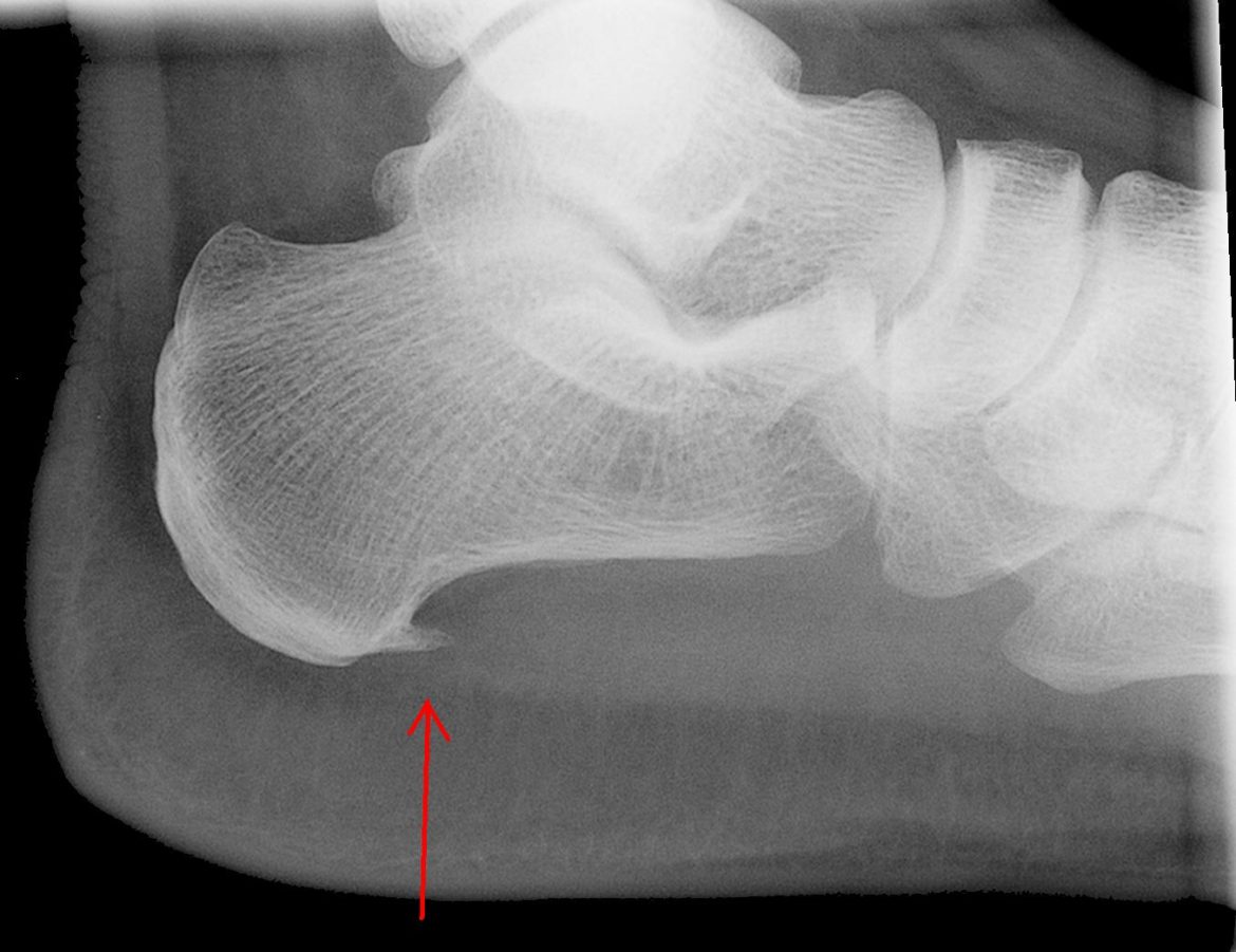 A X-ray demonstrating a heel spur on the calcaneus caused by plantar fasciitis
