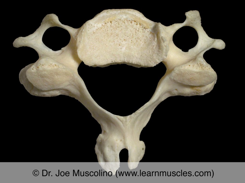 Superior view of C5 ("typical cervical vertebra"). 