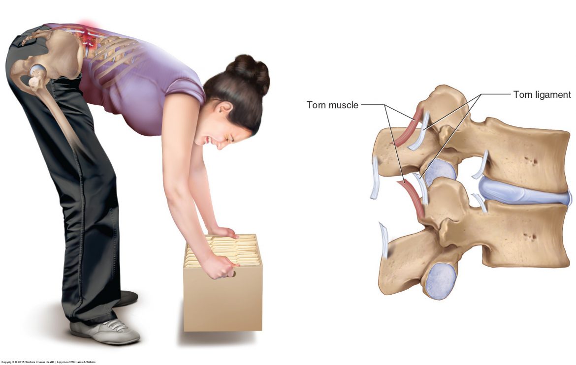 Sprains and Strains of the Low Back and Pelvis can occur simply by bending forward