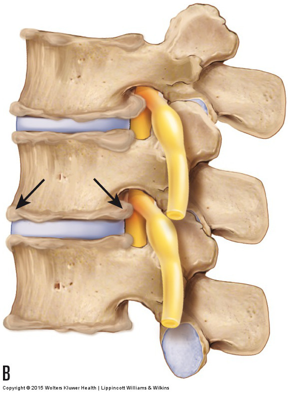 Bone spurs of degenerative joint disease (osteoarthritis)