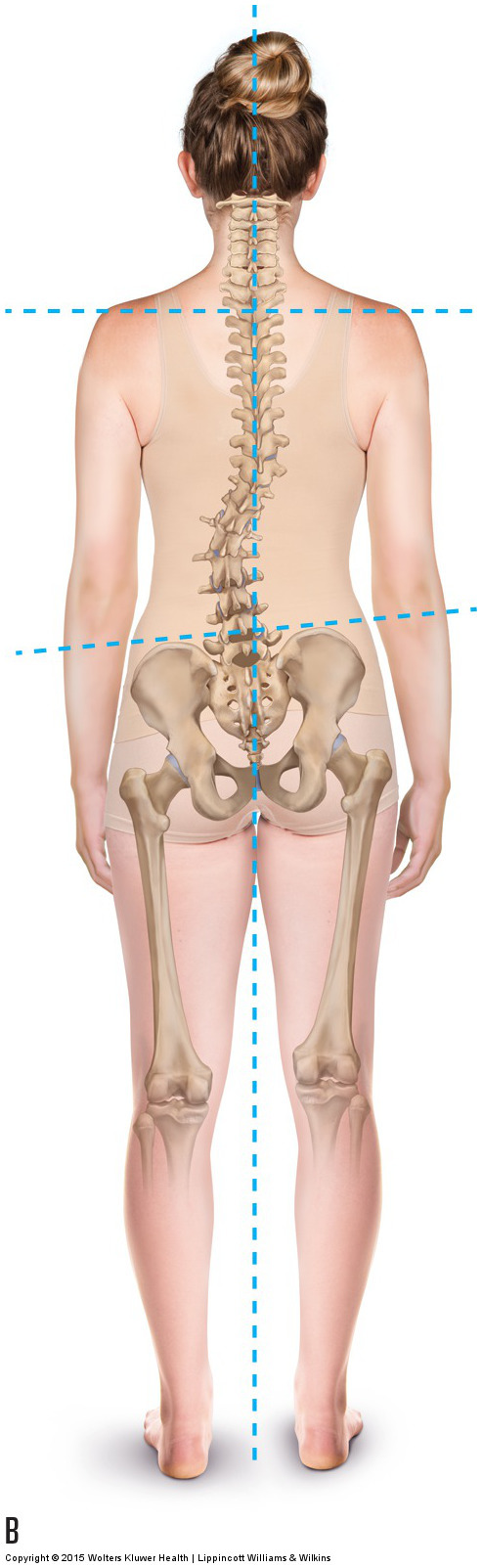 A dropped arch drops the iliac crest height on that side, resulting in a compensatory scoliosis.