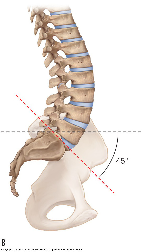 an increased sacral base angle of 45 degrees