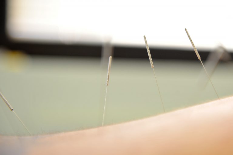 Acupuncture improves carpal tunnel syndrome by rewiring the brain