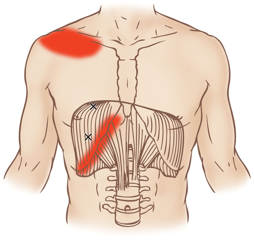 Diaphragm - Trigger Point - Learn Muscles