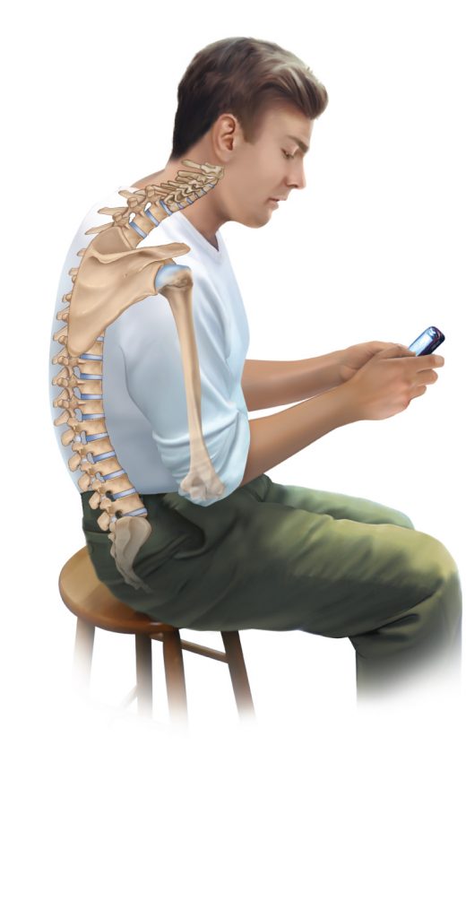 Smart phone use can lead to rounded shoulders