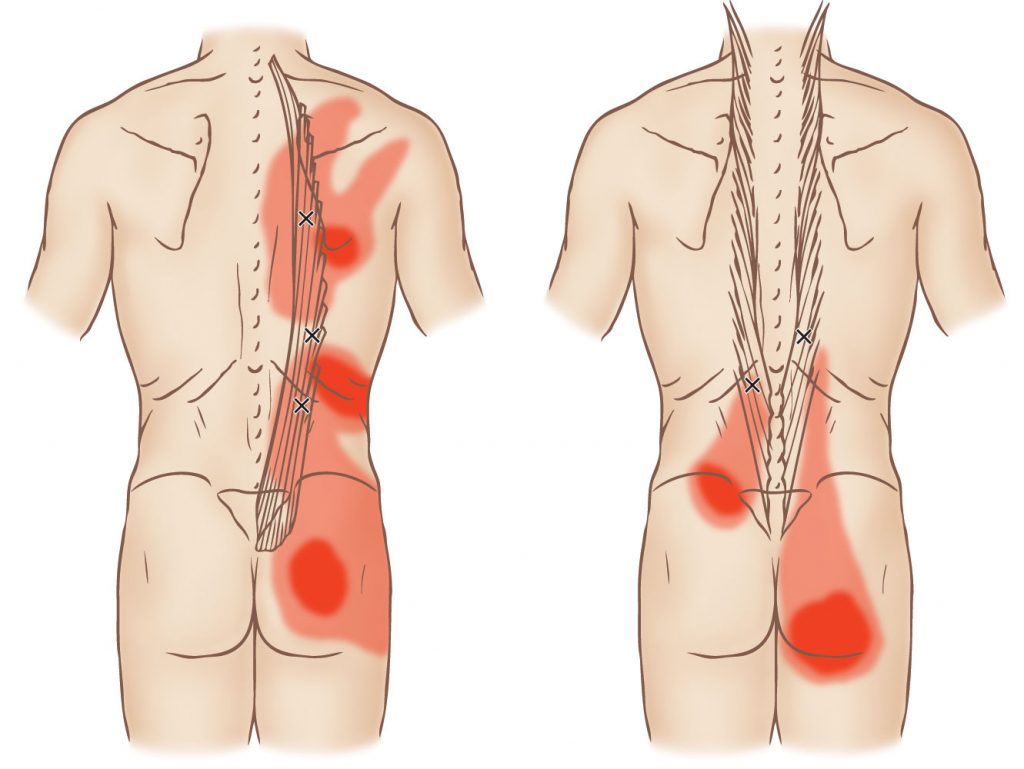Подвздошно поясничная мышца триггеры