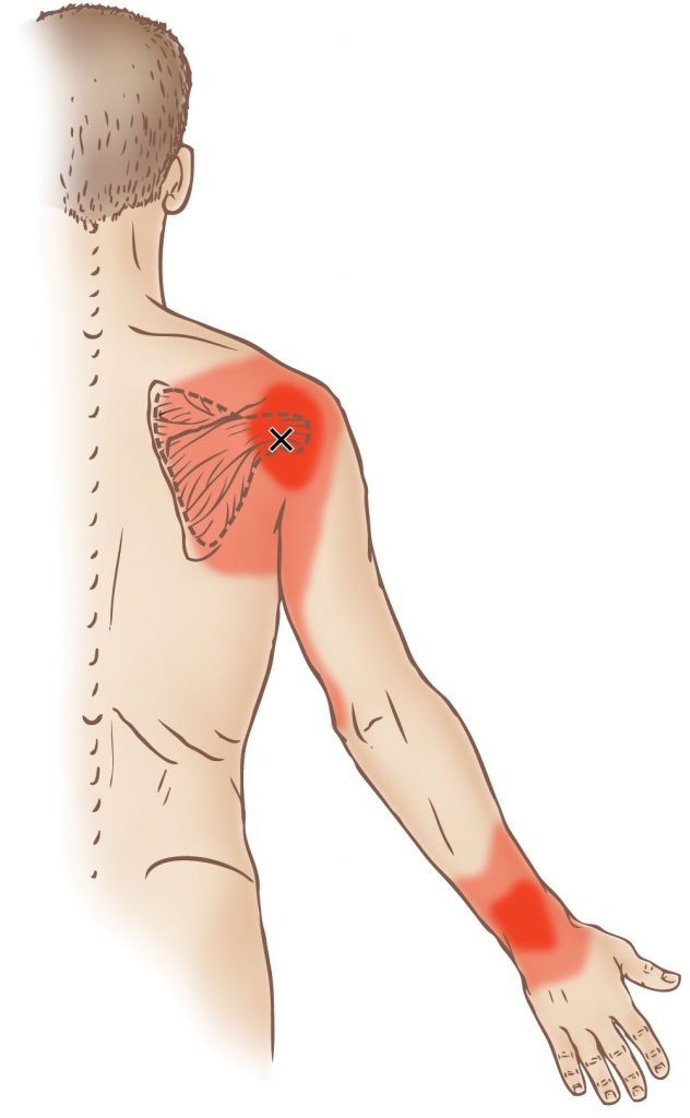 subscapularis-trigger-point-learn-muscles