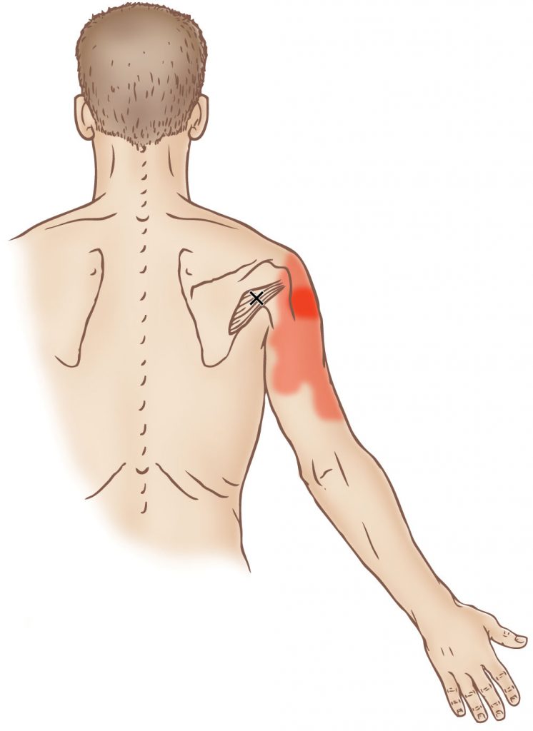 При вдохе болит между лопатками. Подостная мышца триггерные точки. Мышца между лопаткой и позвоночником. Триггерные точки между лопатками. Триггерные точки дельтовидной мышцы.
