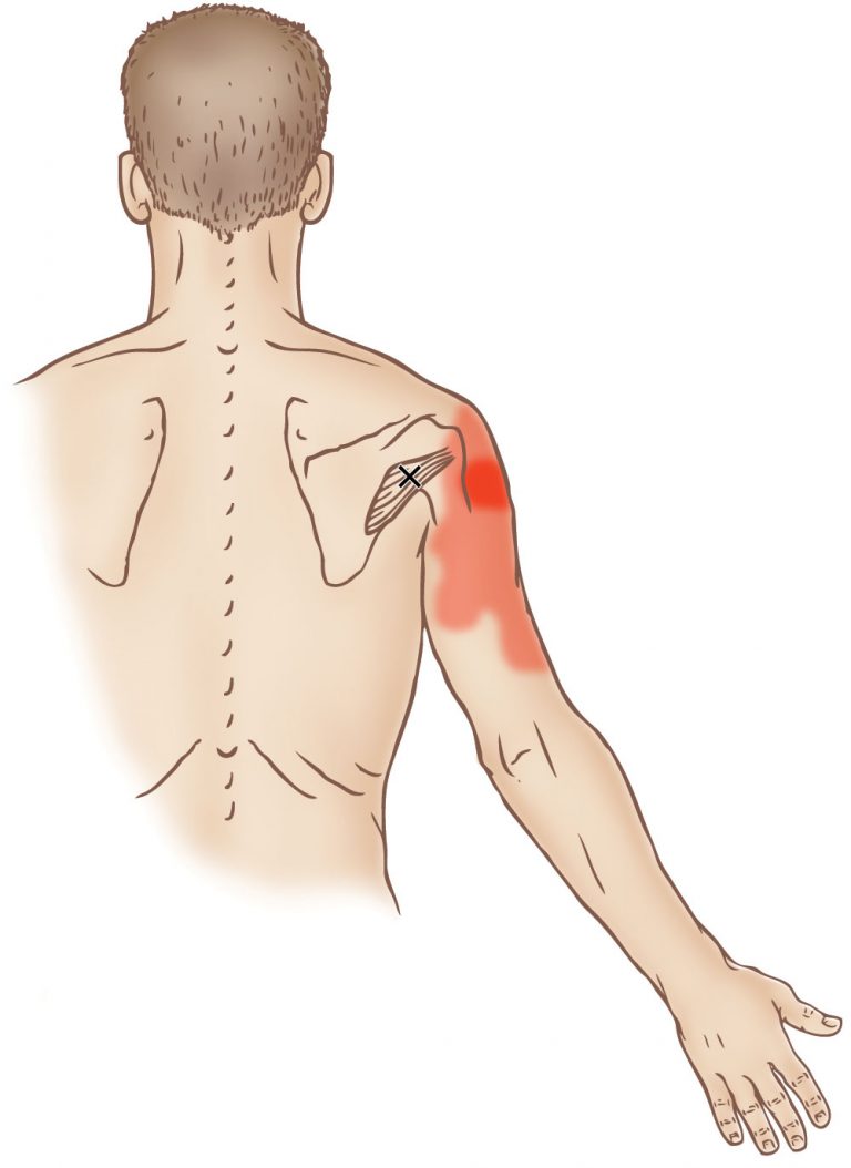 Teres minor - Trigger Point - Learn Muscles