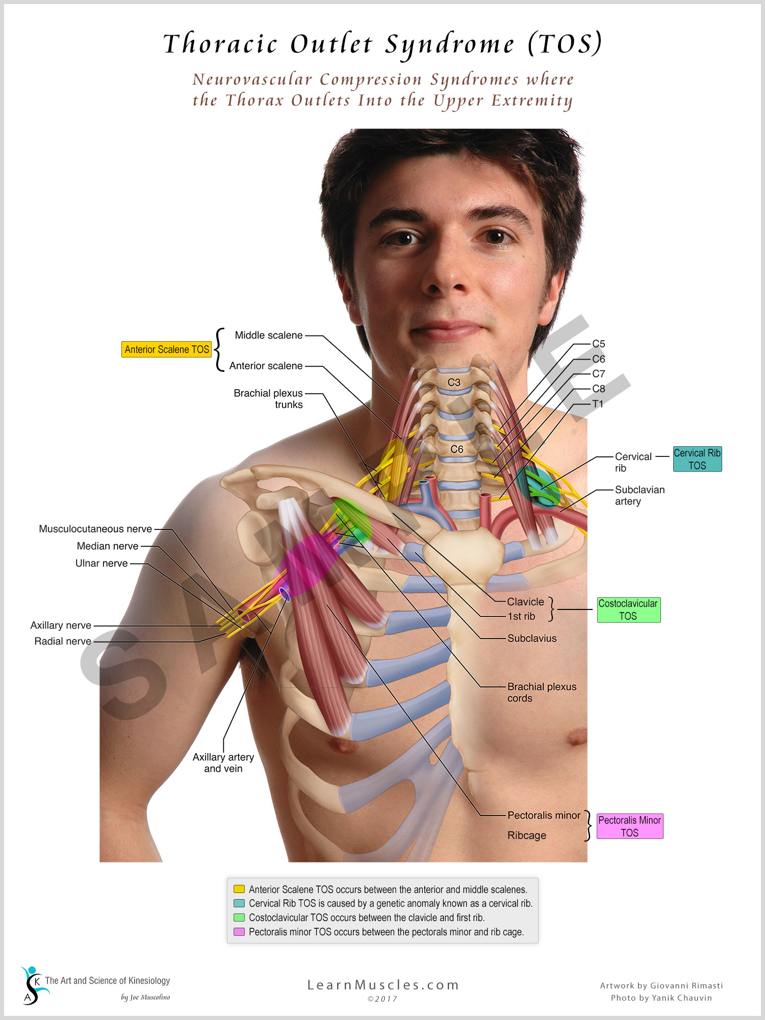 Thoracic Outlet Syndrome 18 x 24 Premium Poster - Learn Muscles