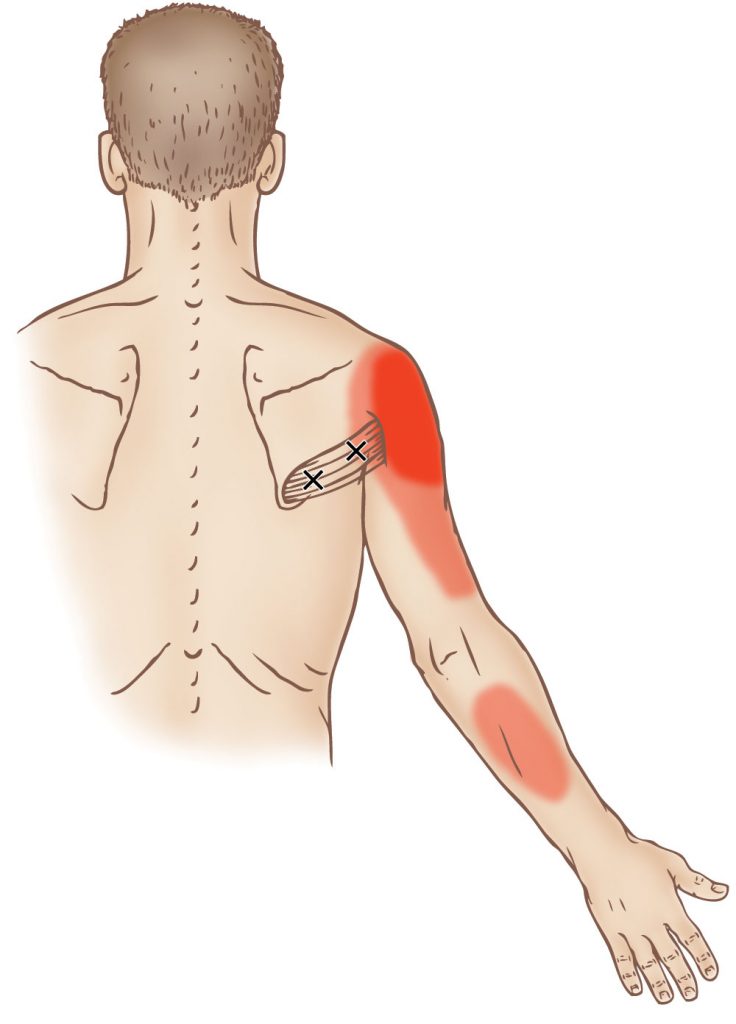 Teres major - Trigger Point - Learn Muscles