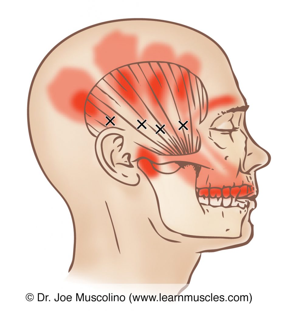 Lateral view of myofascial trigger points and their corresponding referral zones in the temporalis, right side of the body. 