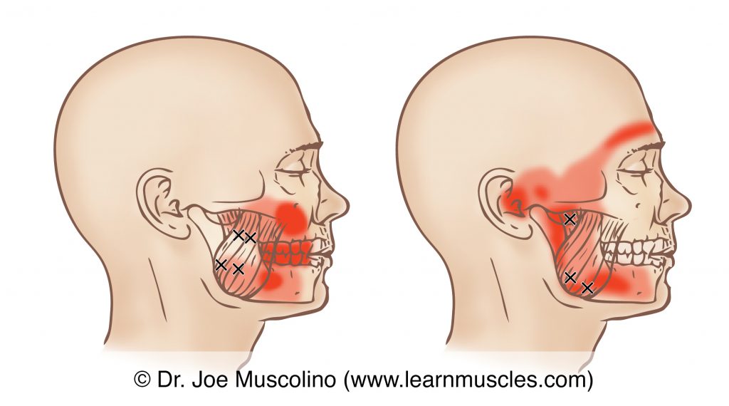 Lateral view of myofascial trigger points and their corresponding referral zones in the masseter, right side of the body. 