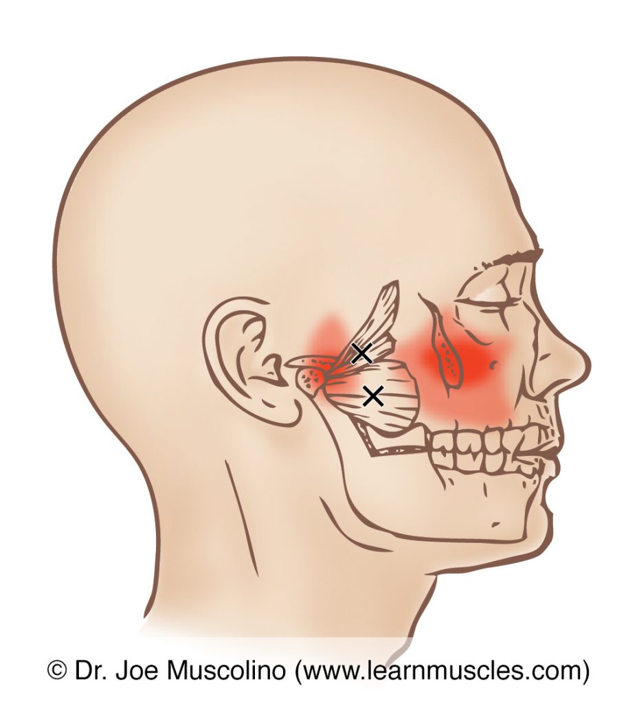 Lateral view of trigger points and their corresponding referral zones in the lateral pterygoid, right side of the body. 