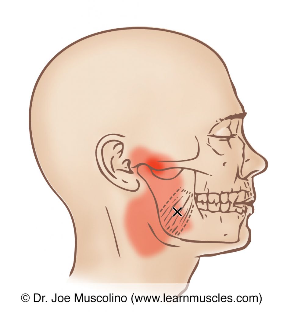 Lateral view of myofascial trigger points and their referral zones in the medial pterygoid, right side of the body.