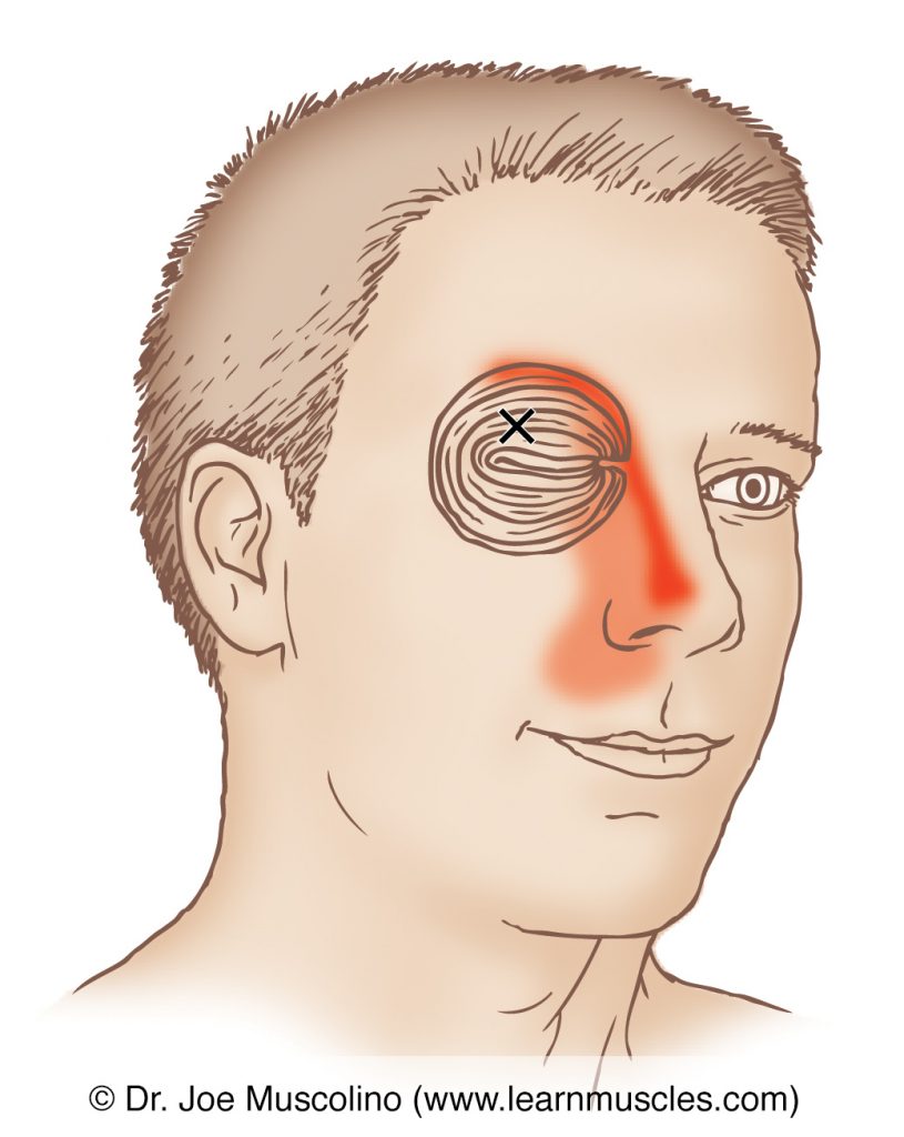 Anterior view of a myofascial trigger point and its referral zone in the orbicularis oculi, right side of the body. 