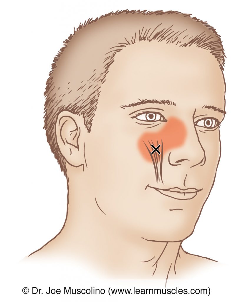 Anterior view of a myofascial trigger point and its referral zone in the levator labii superioris, right side of the body. 