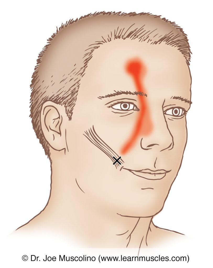 Anterior view of a myofascial trigger point and its referral zone in the zygomaticus major, right side of the body. 