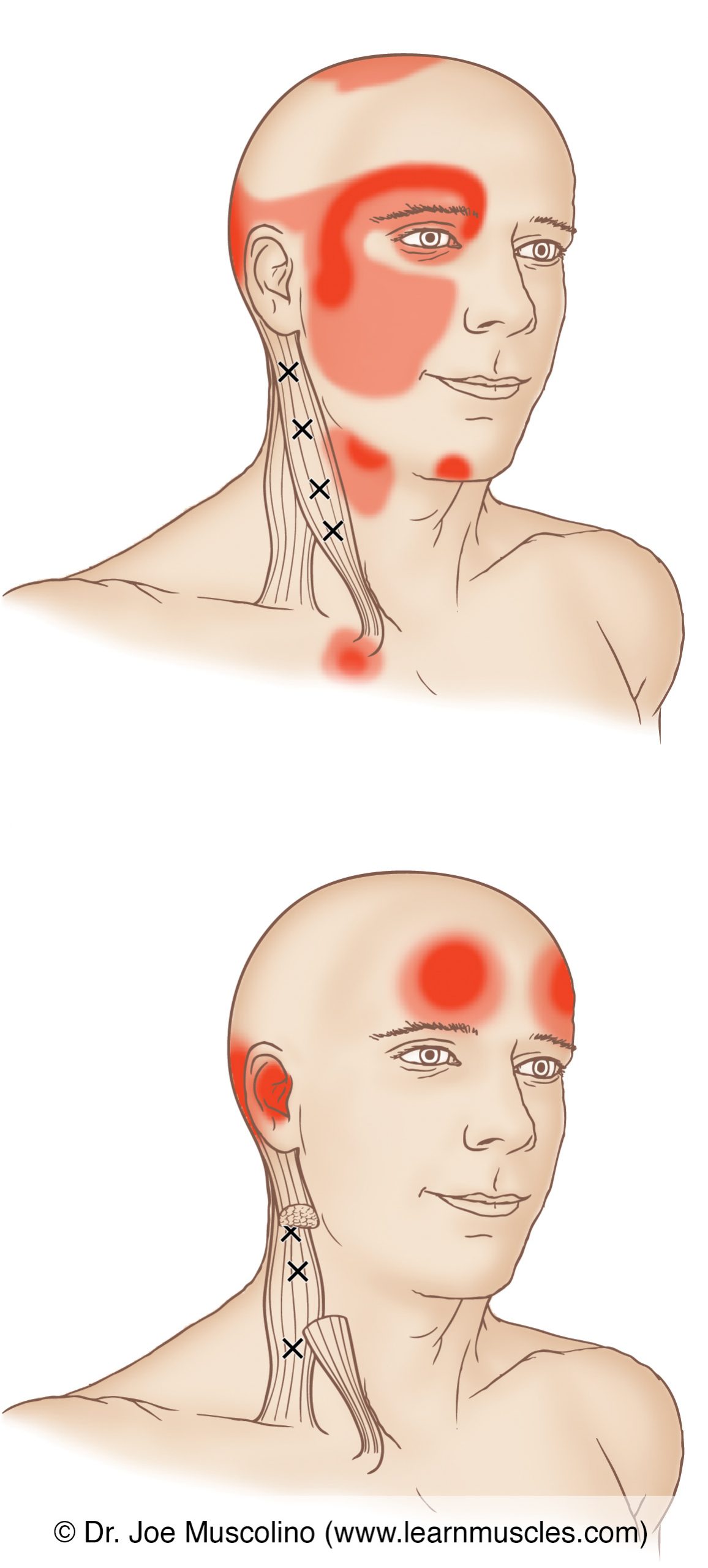 Sternocleidomastoid Scm Trigger Points Learn Muscles 1407