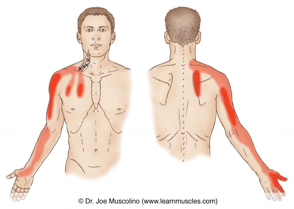 Anterior and posterior views of myofascial trigger points in the right-side scalenes and their corresponding referral zones.