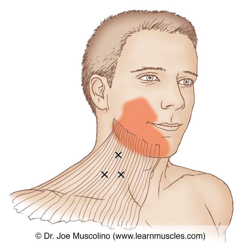 Anterolateral view of myofascial trigger points and their corresponding referral zones in the platysma muscle, right side of the body.