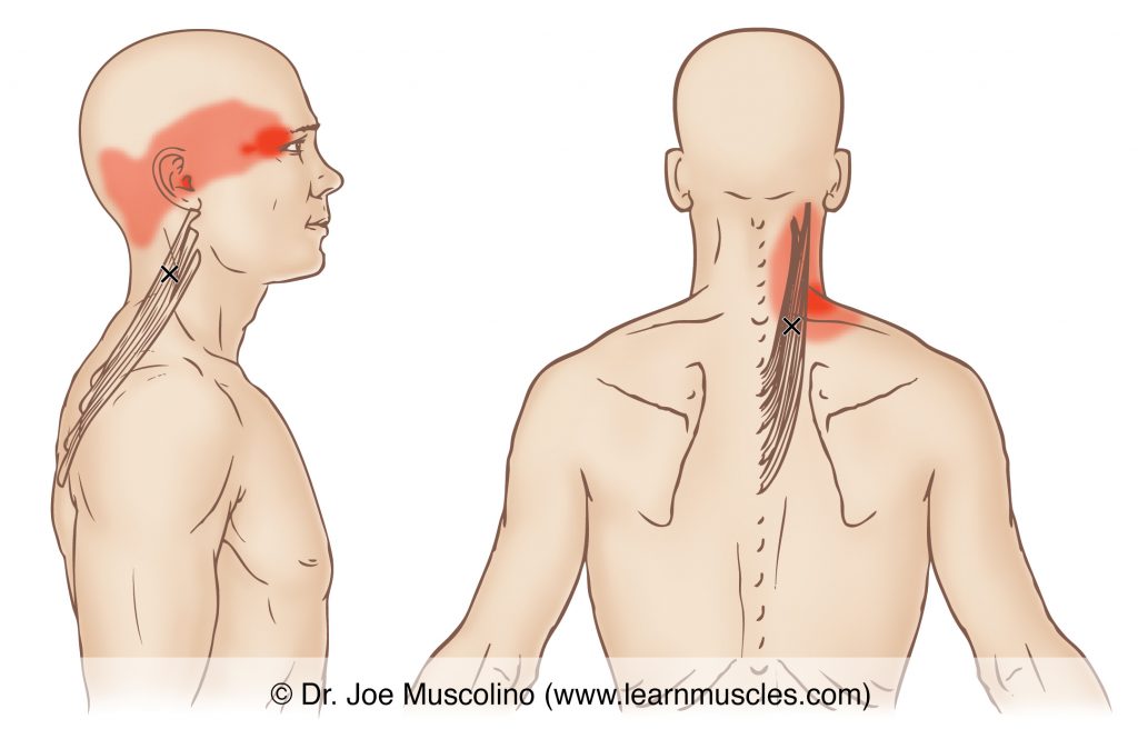 Lateral and posterior views of myofascial trigger points in the right-side splenius cervicis and their corresponding referral zones.