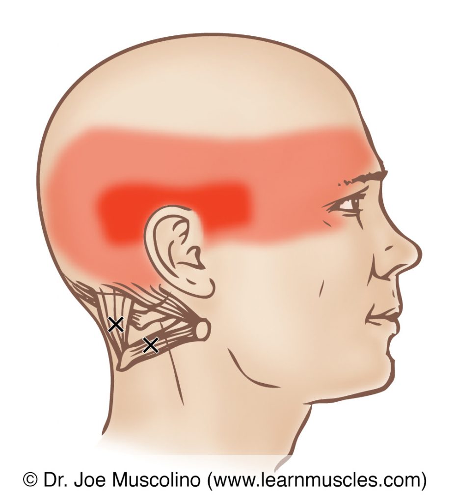 Lateral view of myofascial trigger points in the right-side suboccipital group muscles and their corresponding referral zones.