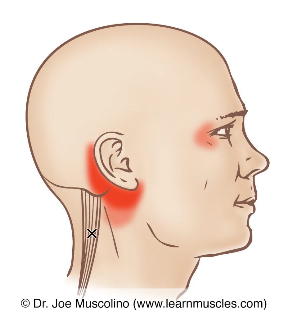 Lateral view of a myofascial trigger point in the right-side longissimus capitis and its corresponding referral zone.