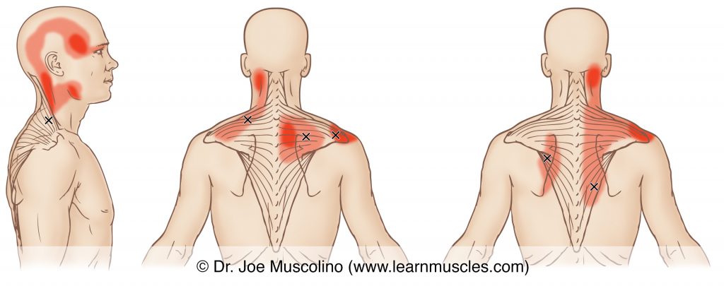 Lateral and posterior views of myofascial trigger points in the trapezius, and their corresponding referral zones.