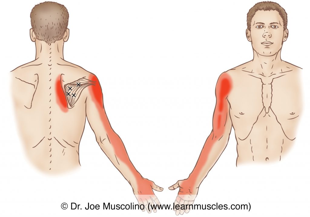 Posterior and anterior views of myofascial trigger points in the right-side infraspinatus and their corresponding referral zones.