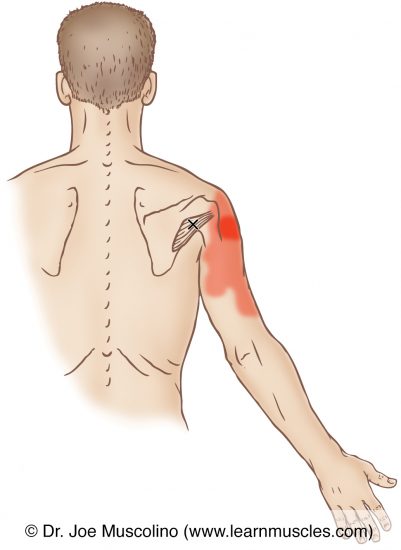 Teres Minor - Trigger Points - Learn Muscles