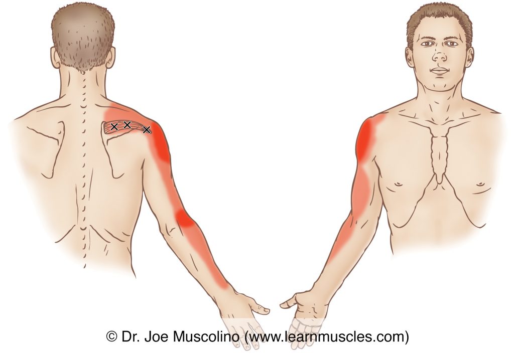 Posterior and anterior views of myofascial trigger points in the right-side supraspinatus and their corresponding referral zones.