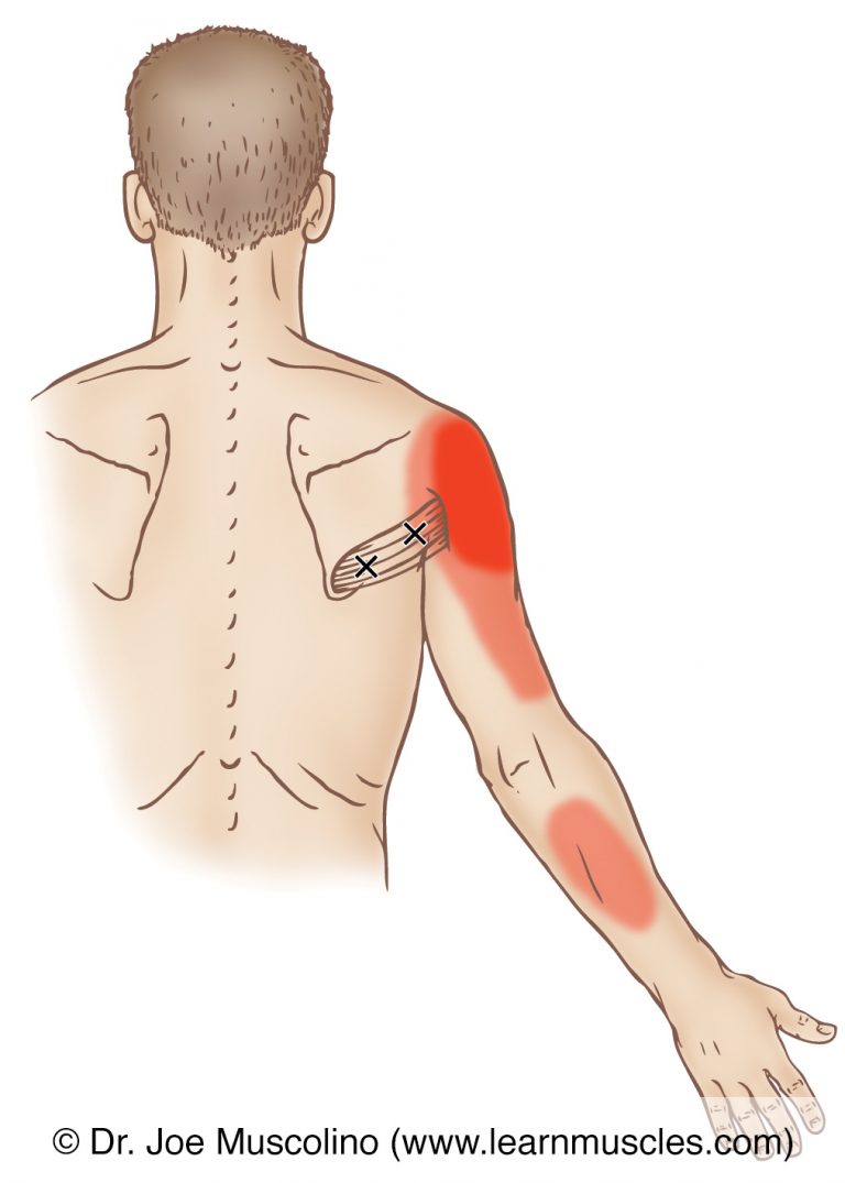 Teres Major - Trigger Points - Learn Muscles