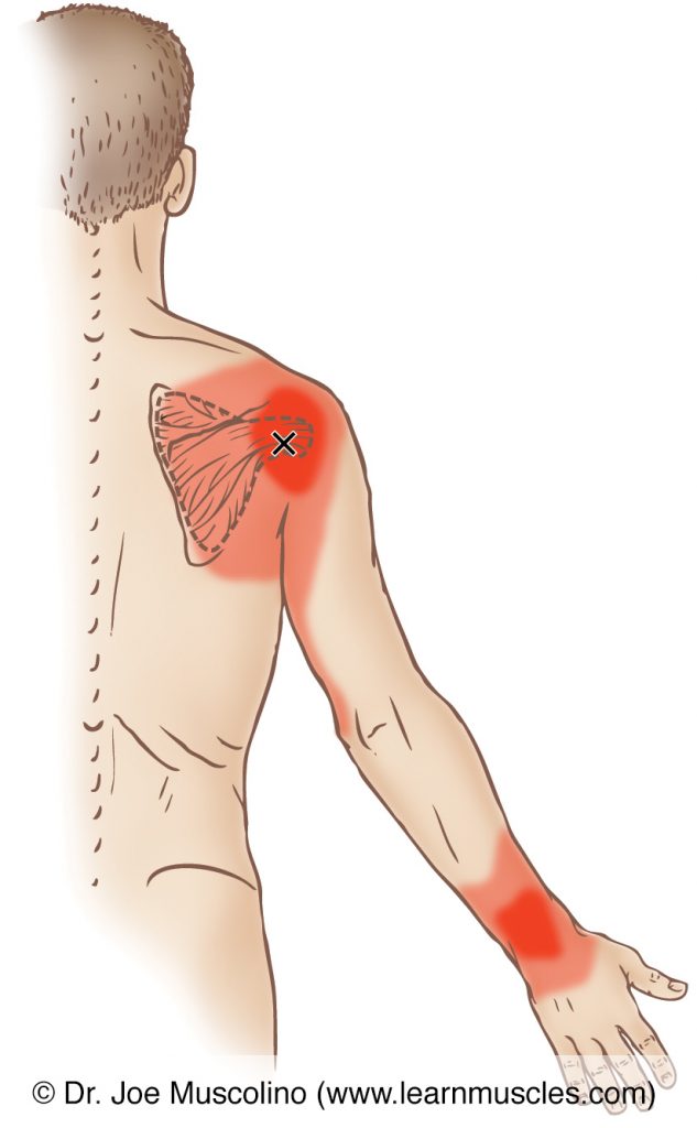 Posterior view of a myofascial trigger point in the right-side subscapularis and its corresponding referral zone.