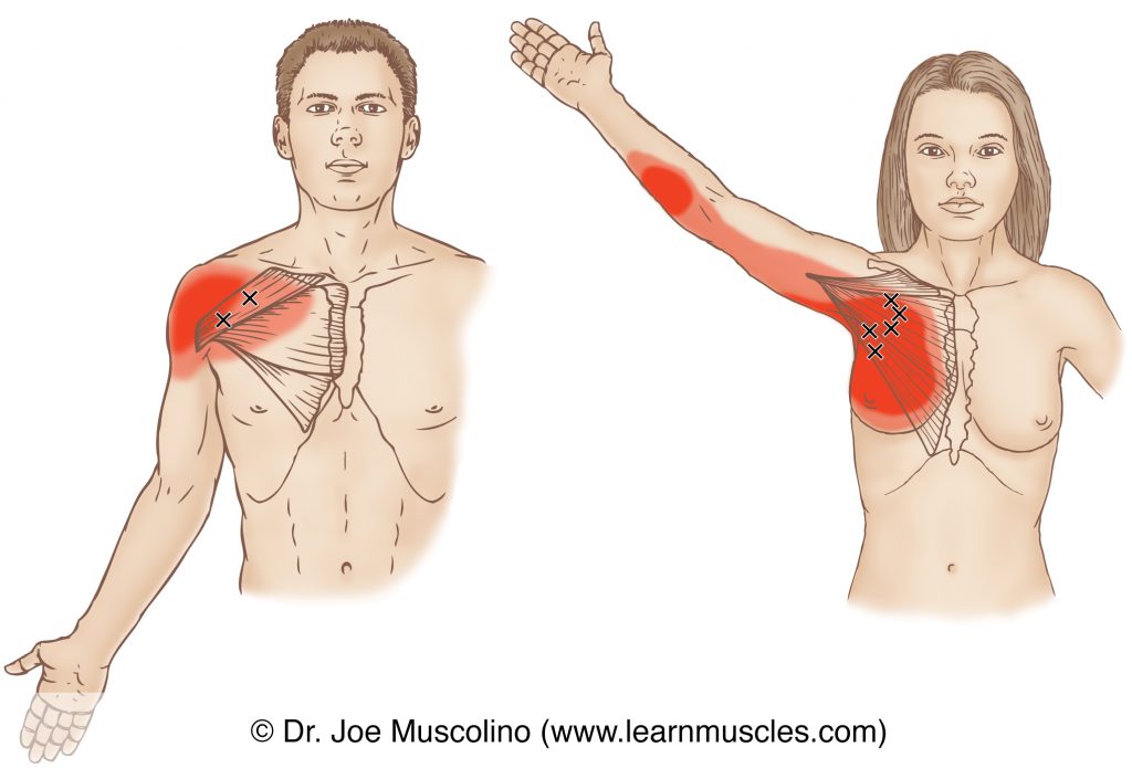 Anterior views of myofascial trigger points in the right-side pectoralis major and their corresponding referral zones.