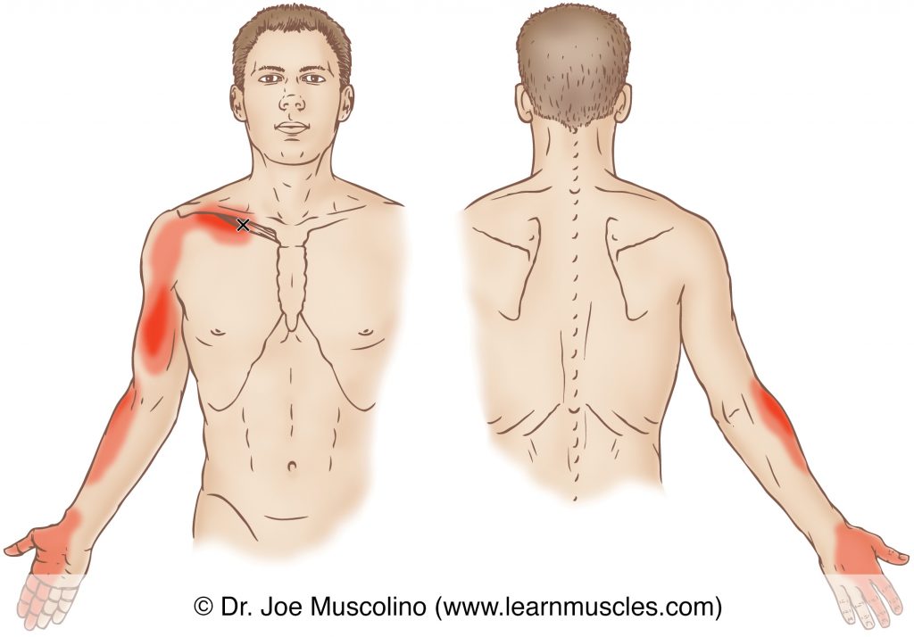 Anterior and posterior views of a myofascial trigger point in the right-side subclavius and its corresponding referral zone.