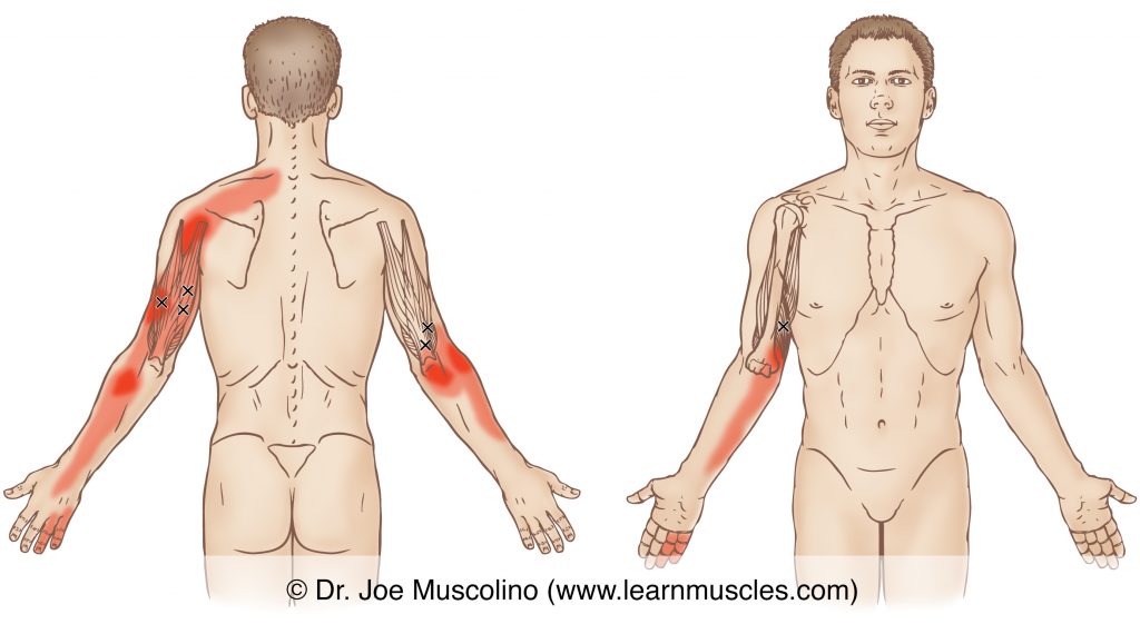 Posterior and anterior views of myofascial trigger points in the right-side triceps brachii and their corresponding referral zones.