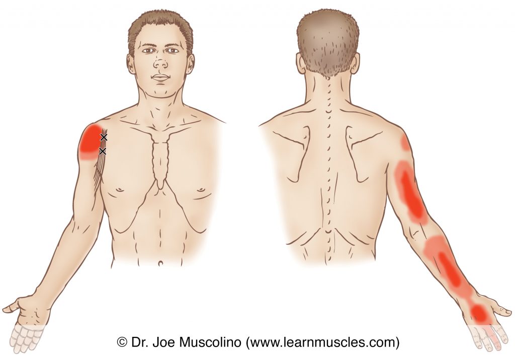 Anterior and posterior views of myofascial trigger points in the right-side coracobrachialis and their corresponding referral zones.