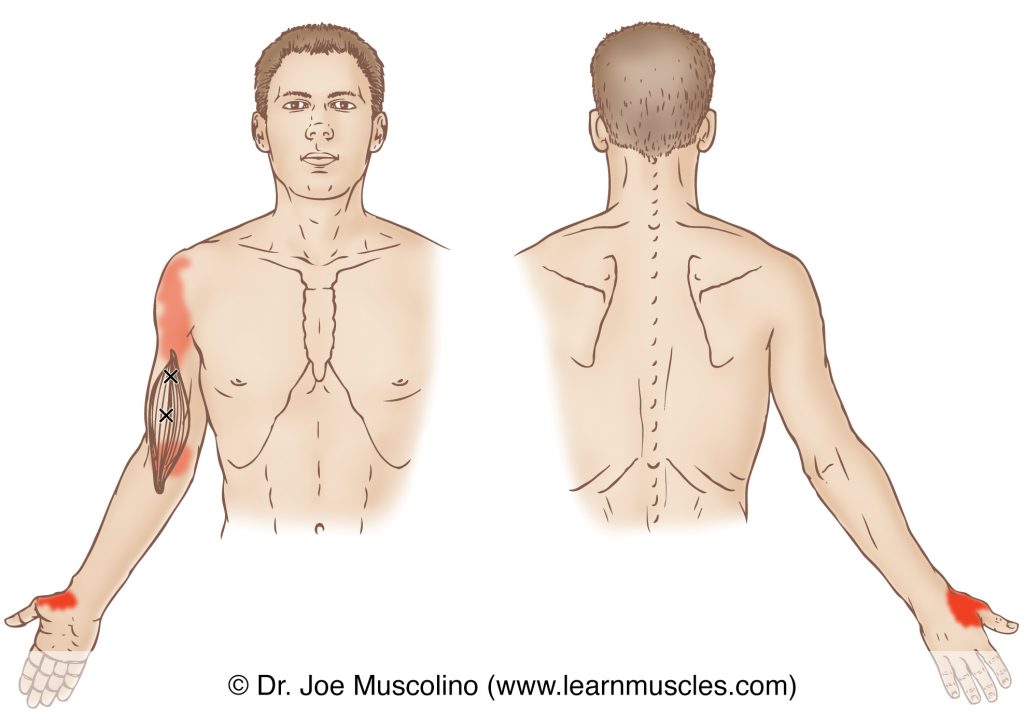 Anterior and posterior views of myofascial trigger points in the right-side brachialis and their corresponding referral zones.