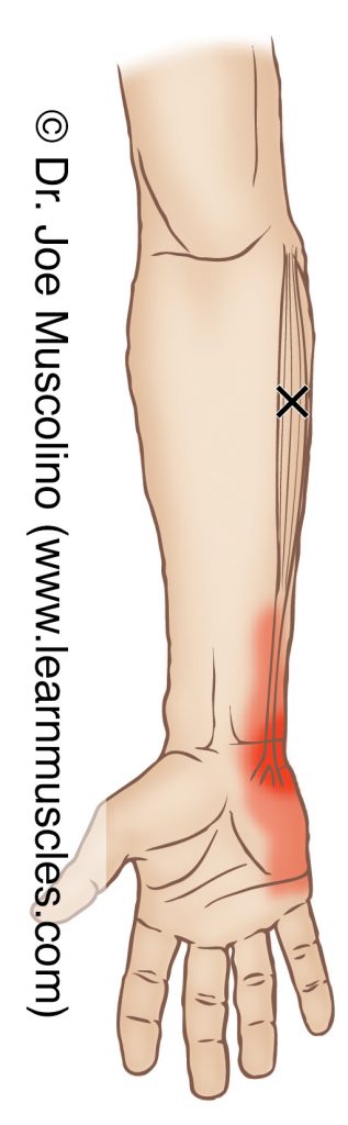 Anterior view of a myofascial trigger point in the right-side flexor carpi ulnaris and its corresponding referral zone.