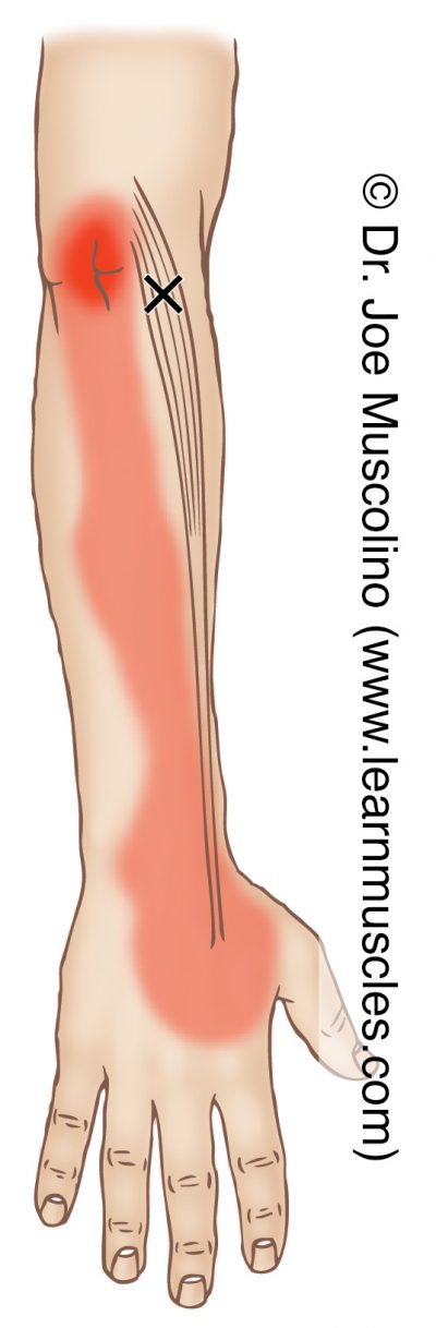 Extensor Carpi Radialis Longus - Trigger Points - Learn Muscles