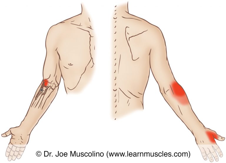 Supinator - Trigger Points - Learn Muscles