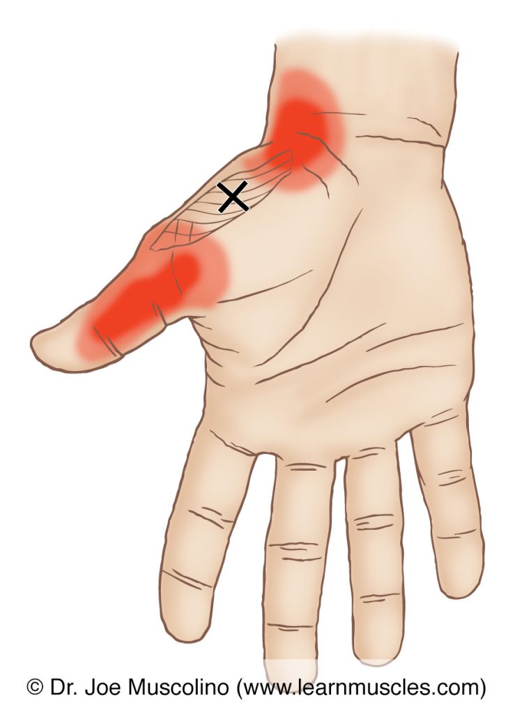 Anterior view of a myofascial trigger point in the right-side opponens pollicis and its corresponding referral zone.