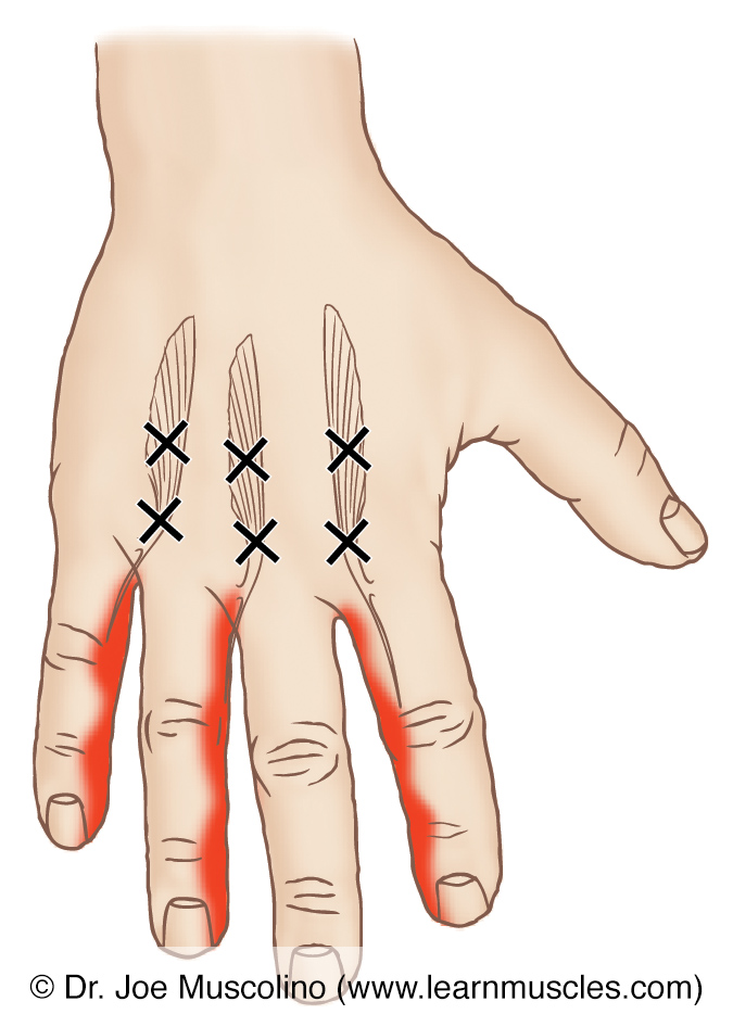 Posterior view of myofascial trigger points in the right-side palmar interossei and their corresponding referral zones.
