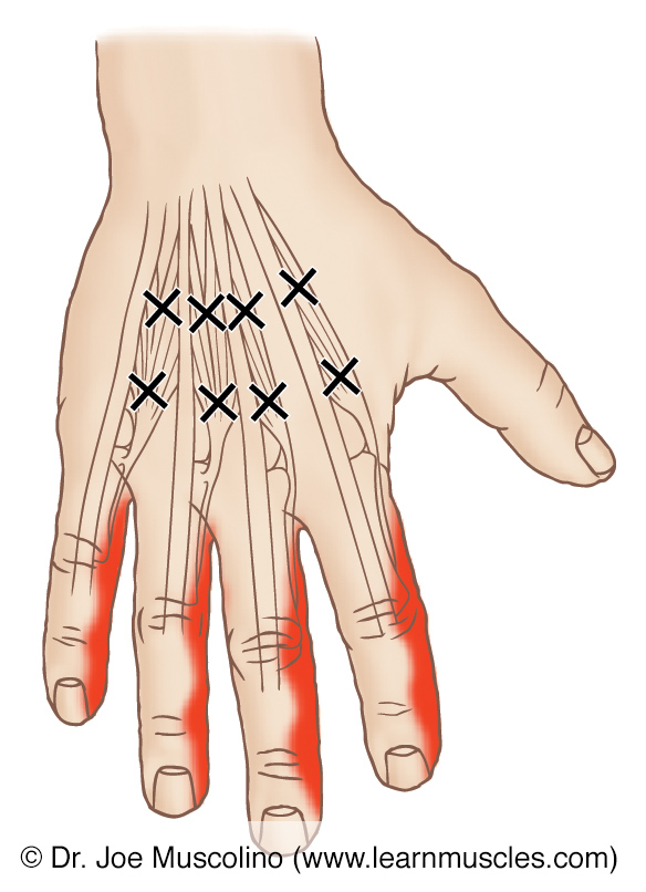 Posterior view of myofascial trigger points in the right-side lumbricals manus and their corresponding referral zones.